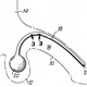 Illustration for article titled Here’s the First Penile Prosthetic That Actually Worked